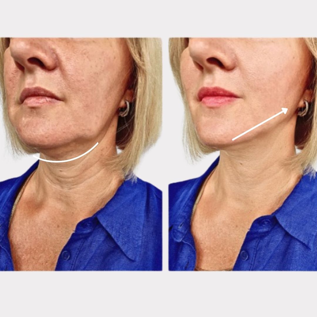 V-LiftUp – Korean Contour Mask for a Firmer, Youthful Face